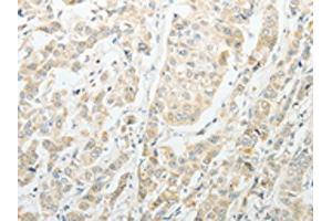 The image on the left is immunohistochemistry of paraffin-embedded Human breast cancer tissue using ABIN7189714(AGBL1 Antibody) at dilution 1/15, on the right is treated with synthetic peptide. (AGBL1 Antikörper)