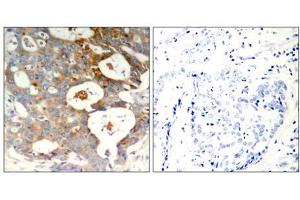 Immunohistochemical analysis of paraffin-embedded human breast carcinoma tissue using IkB-ε (Phospho-Ser22) antibody (E011213). (NFKBIE Antikörper  (pSer22))