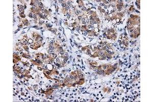 Immunohistochemical staining of paraffin-embedded Carcinoma of prostate tissue using anti-LIPG mouse monoclonal antibody. (LIPG Antikörper)