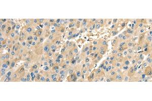 Immunohistochemistry of paraffin-embedded Human liver cancer tissue using COX2 Polyclonal Antibody at dilution 1:40 (COX2 Antikörper)