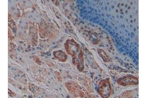 DAB staining on IHC-P; Samples: Human Esophagus cancer Tissue (SNCG Antikörper  (AA 1-121))