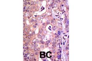 Formalin-fixed and paraffin-embedded human cancer tissue reacted with USP1 polyclonal antibody  , which was peroxidase-conjugated to the secondary antibody, followed by AEC staining.