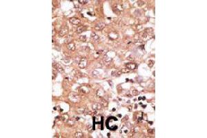 Formalin-fixed and paraffin-embedded human hepatocellular carcinoma tissue reacted with GDF2 polyclonal antibody  , which was peroxidase-conjugated to the secondary antibody, followed by DAB staining. (GDF2 Antikörper  (N-Term))