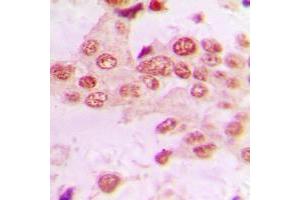 Immunohistochemical analysis of GRK2 staining in human lung cancer formalin fixed paraffin embedded tissue section. (GRK2 Antikörper  (C-Term))