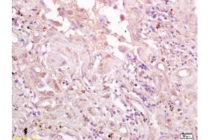 Formalin-fixed and paraffin embedded human lung carcinoma labeled with Anti-CD71/TFR/Transferrin Polyclonal Antibody, Unconjugated (ABIN1386360) at 1:200 followed by conjugation to the secondary antibody and DAB staining. (Transferrin Receptor Antikörper  (AA 621-720))