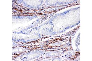Anti-Collagen I antibody, IHC(P): Human Intestinal Cancer Tissue