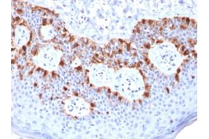 Formalin-fixed, paraffin-embedded human Melanoma stained with MART-1 Mouse Recombinant Monoclonal Antibody (rMLANA/788). (Rekombinanter MLANA Antikörper)