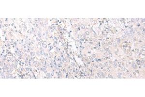 Immunohistochemistry of paraffin-embedded Human cervical cancer tissue using HLA-C Polyclonal Antibody at dilution of 1:25(x200)