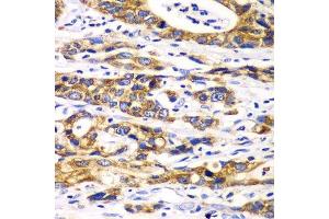 Immunohistochemistry of paraffin-embedded human gastric cancer using RPN1 antibody. (RPN1 Antikörper  (AA 20-280))