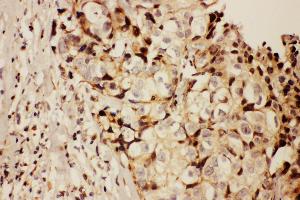 Anti-RFC1 antibody, IHC(P) IHC(P): Human Mammary Cancer Tissue (RFC1 Antikörper  (N-Term))
