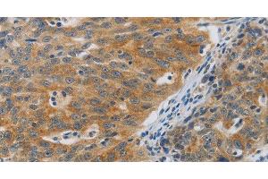 Immunohistochemistry of paraffin-embedded Human ovarian cancer using F2R Polyclonal Antibody at dilution of 1:40 (PAR1 Antikörper)