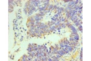 Immunohistochemistry of paraffin-embedded human ovarian cancer using ABIN7164069 at dilution of 1:100 (OCT4 Antikörper  (AA 1-360))