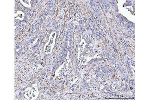 IHC analysis of MT-ND5 using anti-MT-ND5 antibody (ABIN7600145). (MT-ND5 Antikörper  (AA 154-570))