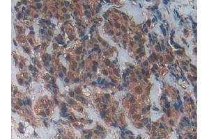 DAB staining on IHC-P; Samples: Human Breast cancer Tissue (CD40 Ligand Antikörper  (AA 180-261))