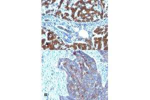 Immunohistochemical staining (Formalin-fixed paraffin-embedded sections) of (A) human hepatocellular carcinoma and (B) human ovarian carcinoma with RBP1 monoclonal antibody, clone RBP/872 .
