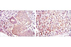 Immunohistochemical analysis of paraffin-embedded ovarian cancer (left) and kidney cancer (right) using MAP2K6 mouse mAb with DAB staining. (MAP2K6 Antikörper)