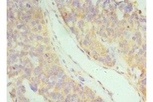 Immunohistochemistry of paraffin-embedded human endometrial cancer using ABIN7156580 at dilution of 1:100 (IFNAR2 Antikörper  (AA 27-243))