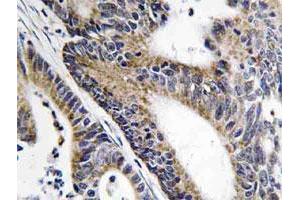 Immunohistochemical analysis of paraffin-embedded human colon cancer tissue using IQCB1 polyclonal antibody . (IQCB1 Antikörper)