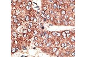IHC analysis of FFPE human hepatocarcinoma tissue stained with the Megalin antibody (LRP2 Antikörper  (AA 4626-4655))