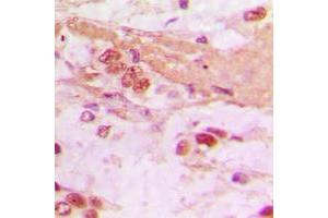Immunohistochemical analysis of TSC22 staining in human lung cancer formalin fixed paraffin embedded tissue section.
