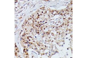 Immunohistochemistry of paraffin-embedded human mammary cancer using IGHMBP2 antibody (ABIN7267848) at dilution of 1:100 (40x lens). (IGHMBP2 Antikörper  (AA 540-720))