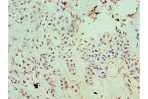 Immunohistochemistry of paraffin-embedded human breast cancer using ABIN7170006 at dilution of 1:100 (SLC2A2 Antikörper  (AA 235-485))