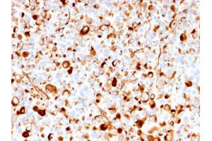 Formalin-fixed, paraffin-embedded human Melanoma stained with NGFR Mouse Recombinant Monoclonal Antibody (rNGFR/1965). (Rekombinanter NGFR Antikörper  (AA 281-421))