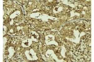 ABIN6273244 at 1/100 staining Human breast cancer tissue by IHC-P. (FBXW7 Antikörper)