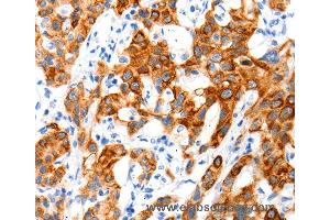 Immunohistochemistry of Human cervical cancer using SLC2A11 Polyclonal Antibody at dilution of 1:140