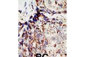 Formalin-fixed and paraffin-embedded human cancer tissue reacted with the primary antibody, which was peroxidase-conjugated to the secondary antibody, followed by DAB staining. (BAP1 Antikörper  (N-Term))