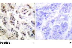 Immunohistochemical analysis of paraffin-embedded human breast carcinoma tissue using LMNA polyclonal antibody . (Lamin A/C Antikörper)