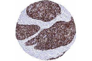 Skin Squamous cell carcinoma showing a strong GLUT1 immunostaining of tumor cells (Rekombinanter GLUT1 Antikörper  (AA 203-305))