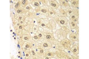 Immunohistochemistry of paraffin-embedded Human liver damage using PSMD2 Polyclonal Antibody at dilution of 1:100 (40x lens). (PSMD2 Antikörper)