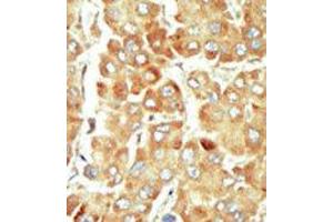 Formalin-fixed and paraffin-embedded human cancer tissue reacted with the primary antibody, which was peroxidase-conjugated to the secondary antibody, followed by DAB staining. (SRPK1 Antikörper  (N-Term))