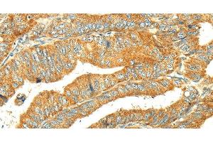 Immunohistochemistry of paraffin-embedded Human colon cancer tissue using GK1 Polyclonal Antibody at dilution 1:60