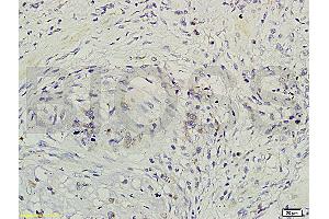 Formalin-fixed and paraffin-embedded rat brain labeled with Rabbit Anti-GRB2/ASH Polyclonal Antibody (ABIN686932) , Unconjugated 1:200 followed by conjugation to the secondary antibody and DAB staining (GRB2 Antikörper)