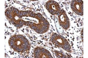 IHC-P Image Immunohistochemical analysis of paraffin-embedded human colon carcinoma, using MEK2, antibody at 1:500 dilution.