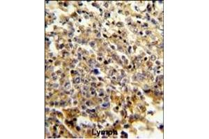 Formalin-fixed and paraffin-embedded human lymphoma reacted with NCF4 Antibody (C-term), which was peroxidase-conjugated to the secondary antibody, followed by DAB staining.