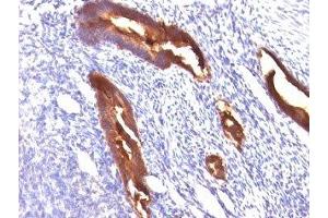 Formalin-fixed, paraffin-embedded human endometrial carcinoma stained with EMA antibody (MUC1/845). (MUC1 Antikörper)