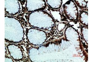 Immunohistochemical analysis of paraffin-embedded human-colon-cancer, antibody was diluted at 1:200