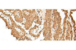 Immunohistochemistry of paraffin-embedded Human thyroid cancer tissue using VPS50 Polyclonal Antibody at dilution of 1:45(x200) (Syndetin/VPS50 Antikörper)