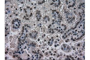 Immunohistochemical staining of paraffin-embedded Carcinoma of kidney tissue using anti-NRBP1mouse monoclonal antibody. (NRBP1 Antikörper)