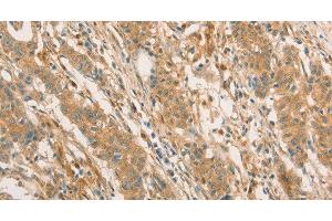 Immunohistochemistry of paraffin-embedded Human gastric cancer using CPB1 Polyclonal Antibody at dilution of 1:60 (CPB1 Antikörper)