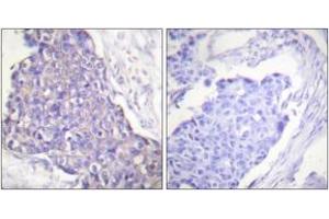 Immunohistochemistry analysis of paraffin-embedded human breast carcinoma tissue, using CD40 Antibody. (CD40 Antikörper  (AA 228-277))