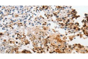 Immunohistochemistry of paraffin-embedded Human cervical cancer using LCN2 Polyclonal Antibody at dilution of 1:60 (Lipocalin 2 Antikörper)