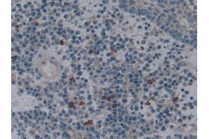 Detection of HO1 in Human Skin cancer Tissue using Polyclonal Antibody to Heme Oxygenase 1 (HO1) (HMOX1 Antikörper  (AA 61-172))