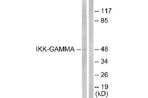 Immunohistochemical analysis of paraffin-embedded human lung carcinoma tissue using IKK-γ (Ab-31) Antibody. (IKBKG Antikörper  (Ser31))
