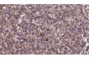 ABIN6276846 at 1/100 staining Human liver cancer tissue by IHC-P. (GABRG2 Antikörper  (N-Term))