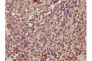 IHC image of ABIN7173067 diluted at 1:350 and staining in paraffin-embedded human ovarian cancer performed on a Leica BondTM system. (TMEM14A Antikörper  (AA 45-78))