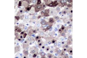 Immunohistochemical analysis of XPO2 staining in human liver cancer formalin fixed paraffin embedded tissue section. (Exportin 2 Antikörper  (N-Term))